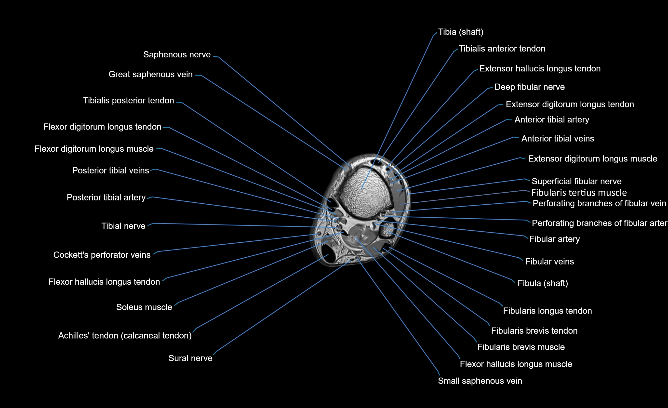 MRI lower leg axial cross sectional anatomy 3T  radiology  image-img-00001-00094.webp